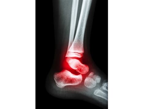 Rheumatoid Arthritis Of The Ankle