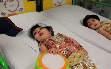 Conjoined Twins Separated After 50 Hours Of Surgery At Great Ormond Street Hospital