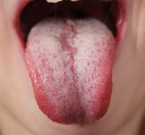 Introduction To Tongue Assessment For The Western Herbalist Herbalist