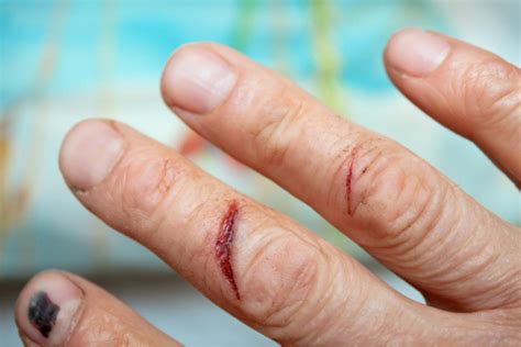 The Ultimate Guide To Preventing Cuts And Lacerations At Work Metro