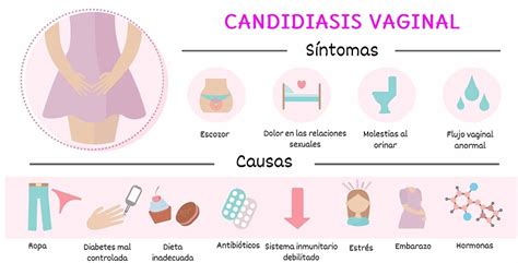 Candidiasis Vaginal Causas S Ntomas Tratamiento