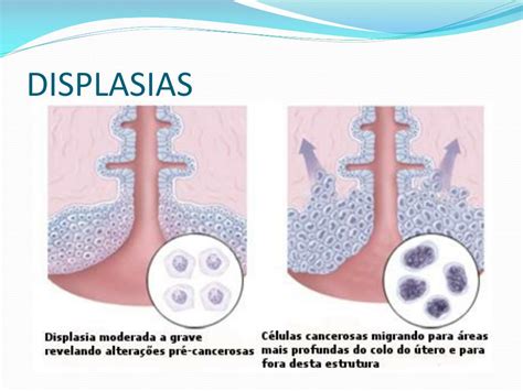Displasia Cervical Grave Não Classificada Em Outra Parte