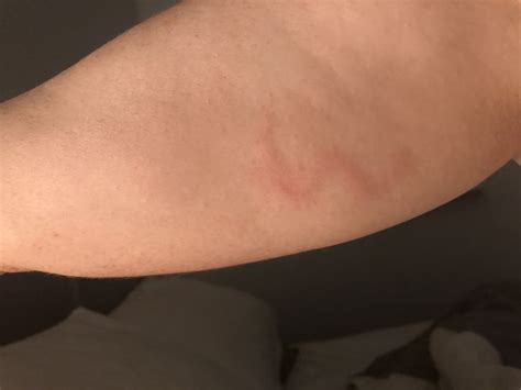 Rash On Arm Parasite On Curezone Image Gallery