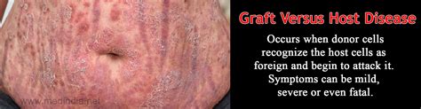 Graft Versus Host Disease Gvhd Types Causes Symptoms Diagnosis