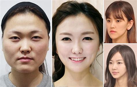 Korean Before And After The Plastic Surgery Vrogue Co