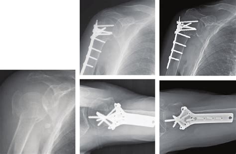 (a) A 71-year-old female patient sustained right proximal ...