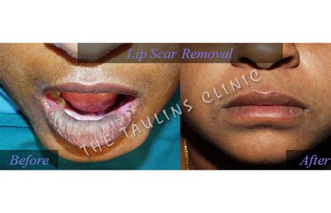 Scar Removal Scar Revision Surgery Bangalore India