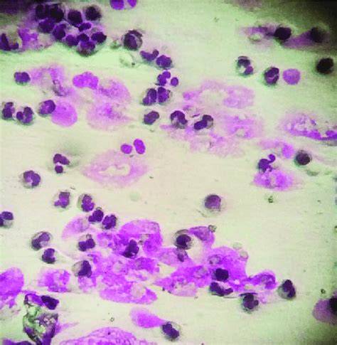 High Number Of Polymorphonuclear Leukocytes Pmns In