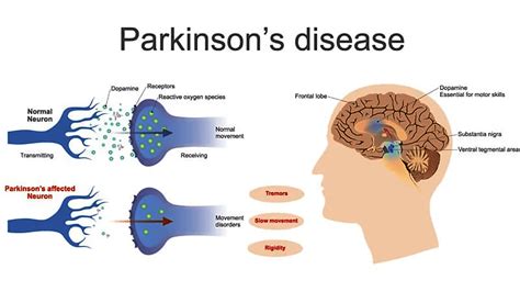 Glutathione Iv For Parkinsons Disease Dr Shiva Lalezar