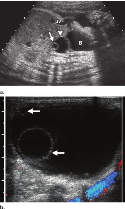 Ovarian Cyst With A Single Septation Axial Fetal Us Image Shows A