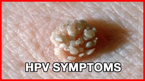 Human Papilloma Virus Symptoms Youtube