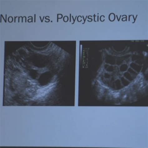 Normal Vs Polycystic Ovaries Ultrasound