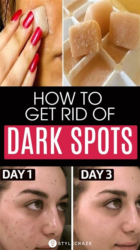 6 Home Remedies To Remove Dark Spots On Face Causes And Types Dark Spots On Skin Brown Spots