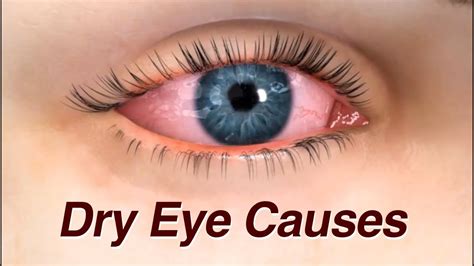 Dry Eye Causes And Treatment Youtube