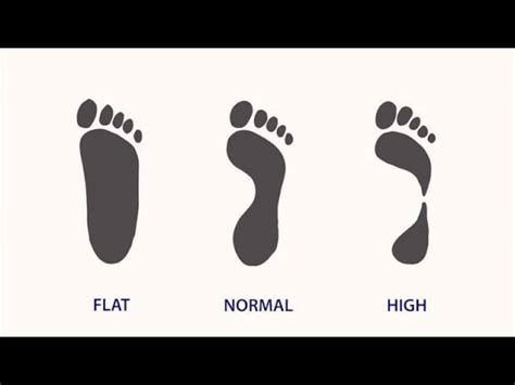 Running With Flat Feet What You Should Know To Stay Injury Free