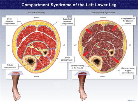 Compartment Syndrome Of The Left Lower Leg Trial Exhibits Inc