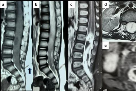 A Rare Entity Infected Congenital Dermal Sinus Tract With Conus