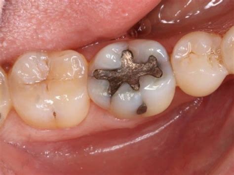 Abscess Tooth Symptoms Intelligent Dental My XXX Hot Girl