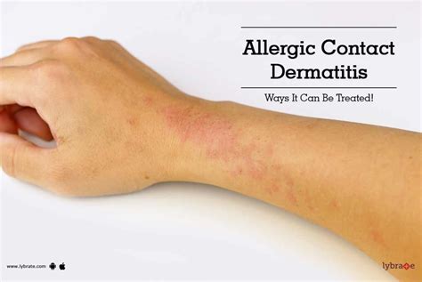 Allergic Contact Dermatitis Ways It Can Be Treated By Dr Vinod