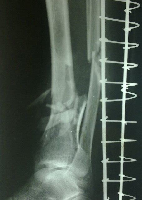 Radiographs Of Tibia Fibula Fracture Bone And Spine