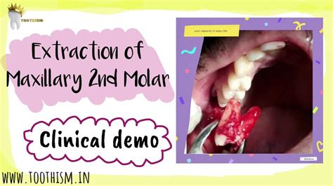 Clinical Demo Of Extraction Of Maxillary 2nd Molar Youtube