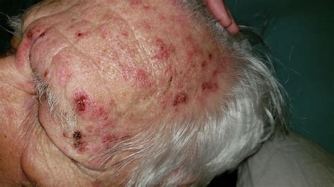 Sulfa Bactrim Rash Dermatologyquestions