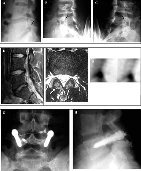 A C Lateral And Oblique Radiographs Of L5 Pars Fractures With