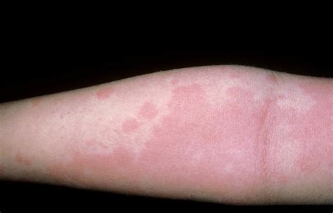 Causes Symptoms And Treatment Of Pressure Urticaria