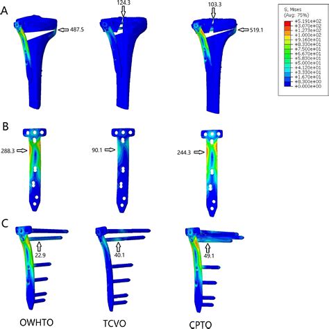 Combined Proximal Tibial Osteotomy For Varus Osteoarthritis Of The Knee