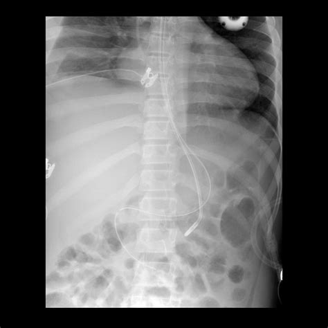 Nasogastric Tube X Ray