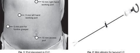 Figure 3 From Two Port Mini Vs Conventional Four Port Vs Singleincision