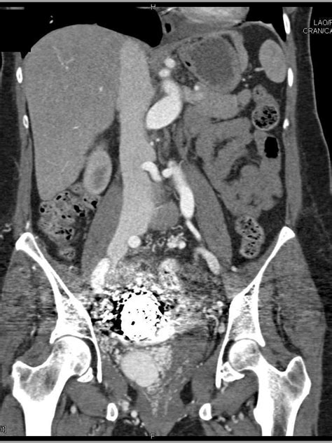 Large Pelvic Avm With Prior Embolization And Remaining Avm Vascular