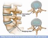 Best Treatment For Bulging Lumbar Disc Images