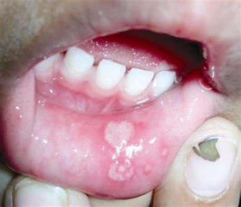 Coxsackie Virus Exanthem Hand Foot Mouth Disease Medical Laboratories