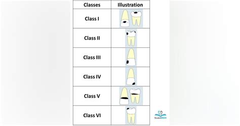 Must Know Classifications Of Dental Caries For The National Dental