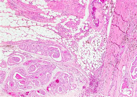 Pathology Outlines Papillary Thyroid Carcinoma Overview