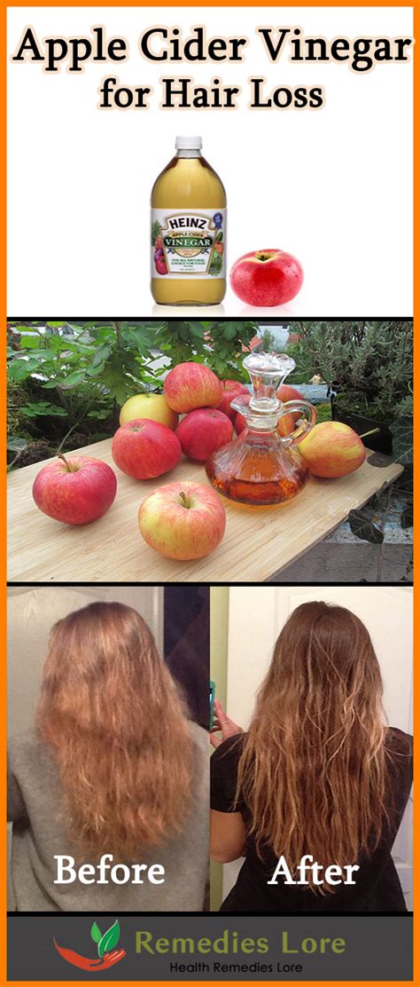 Makes my hair look fuller. Apple Cider Vinegar for Hair Loss - Remedies Lore