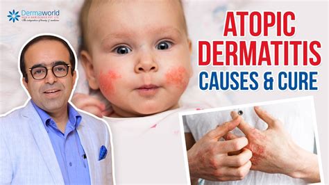 Atopic Dermatitis Causes And Cure Best Treatment Dr Rohit Batra Youtube