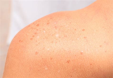 White Spots On Skin From Sun What Are They Cleveland Clinic