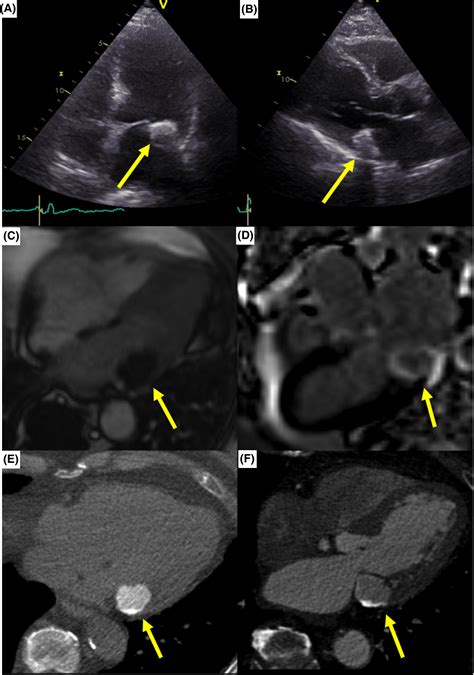Caseous Calcification Of The Mitral Annulus Assessed By Multimodality