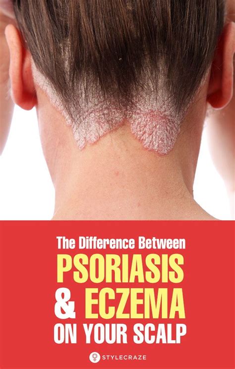 How To Tell The Difference Between Psoriasis And Eczema On Your Scalp