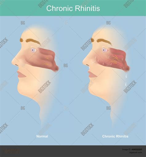 Chronic Rhinitis Vector And Photo Free Trial Bigstock