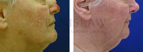 Nose Skin Cancer Gallery 3 Before And After Photos Connecticut