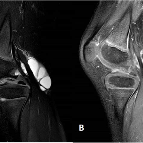 Magnetic Resonance Imaging Mri Mri Sagittal View Of The Left Knee