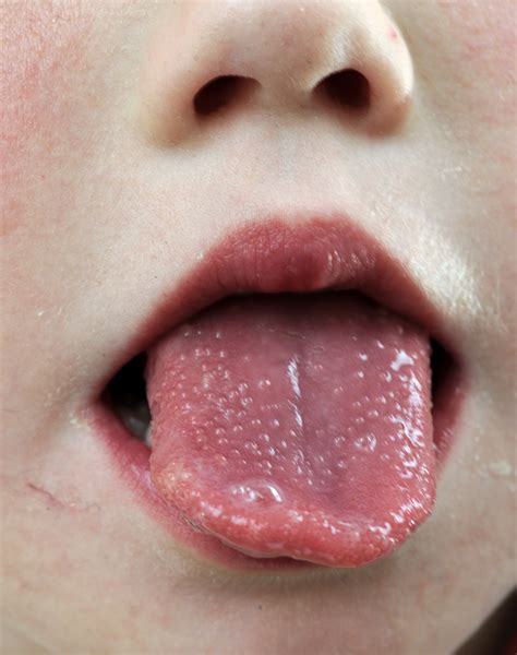 Leider hat uns das coronavirus noch immer fest im griff. Tongue Discoloration and Other Changes - Mouth and Dental ...