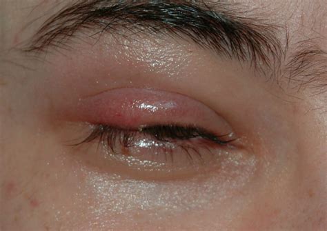 What Does A Stye Look Like What Does It Look Like Find Out Here