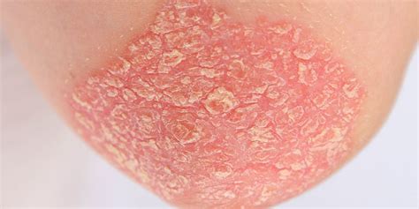 How To Recognize Different Types Of Psoriasis Sharecare