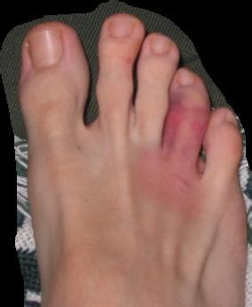Oh snap i broke my pinky toe just a few days ago. Treatment of Toe Injuries : Broken, Sprained, Fractured ...