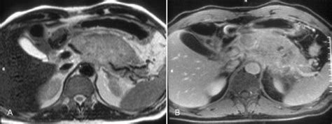 Primary Pancreatic Lymphoma In A 62 Year Old Man A Axial T2 Wi Shows
