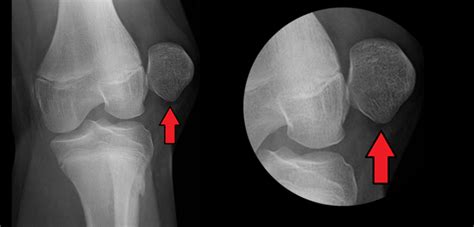 Patella Dislocation Recurrent Or Injury Related Max Superspecialty